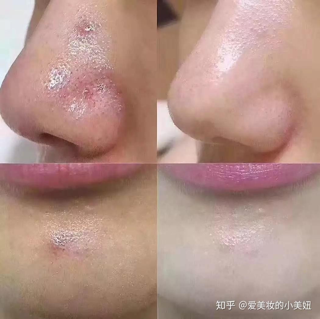 小气泡去黑头去角质效果怎么样