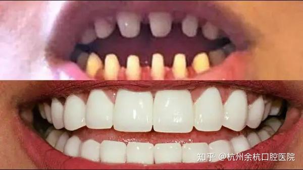 一个牙医的良心忠告 不要随便做烤瓷牙 知乎