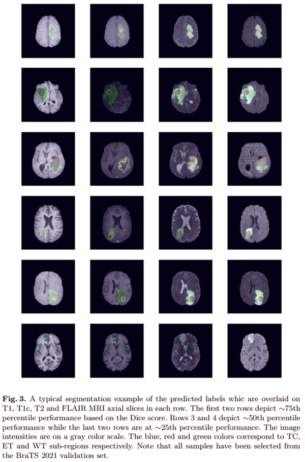 【arXiv:2201】Swin UNETR：用于 MRI 图像中脑肿瘤语义分割的 Swin Transformers - 知乎