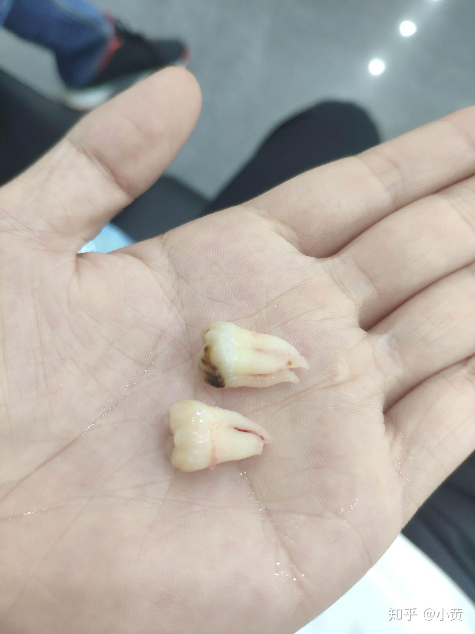 智齿长得很好即正位不痛是什么体验