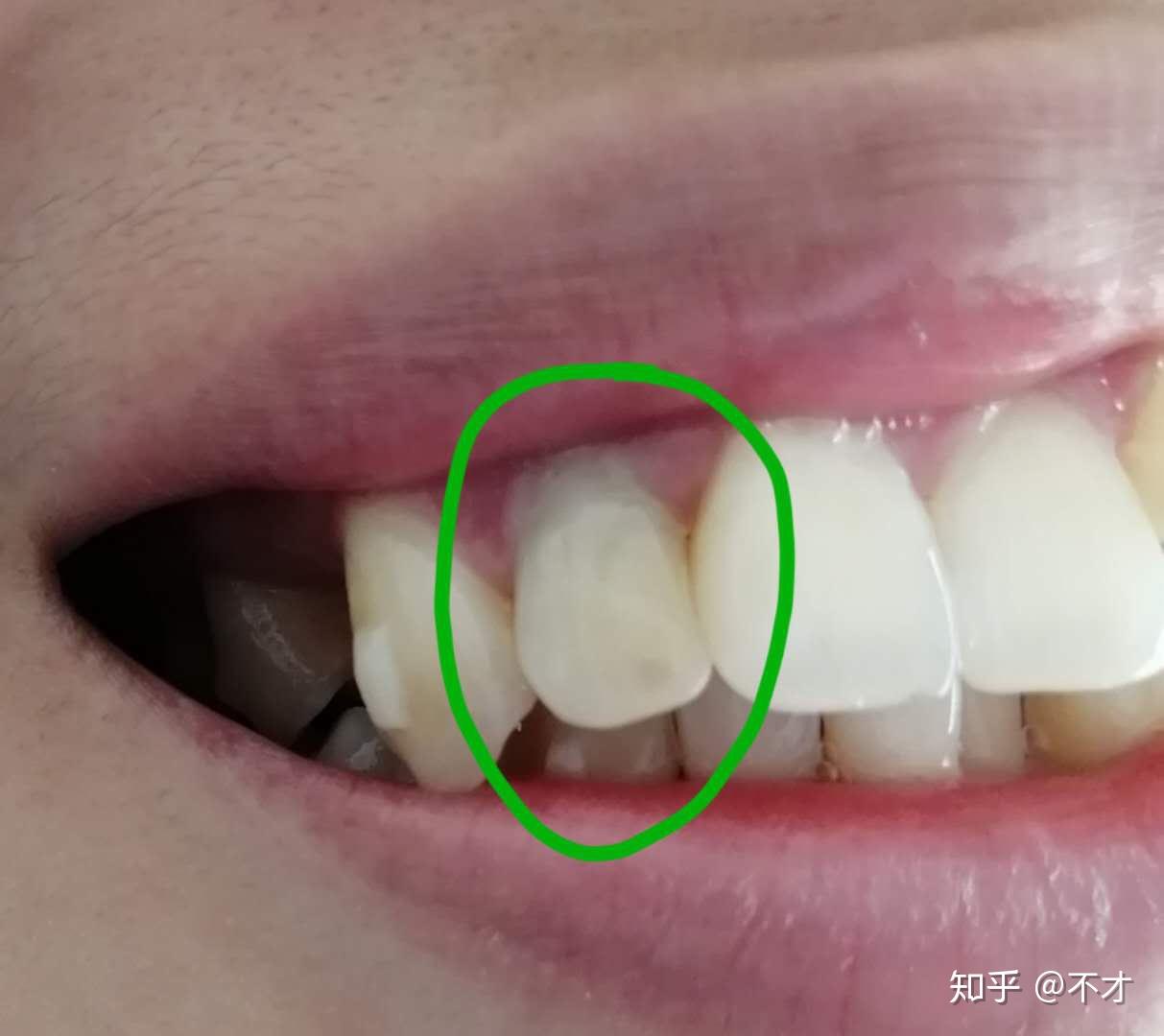 第三部分:门牙补牙——4个牙洞