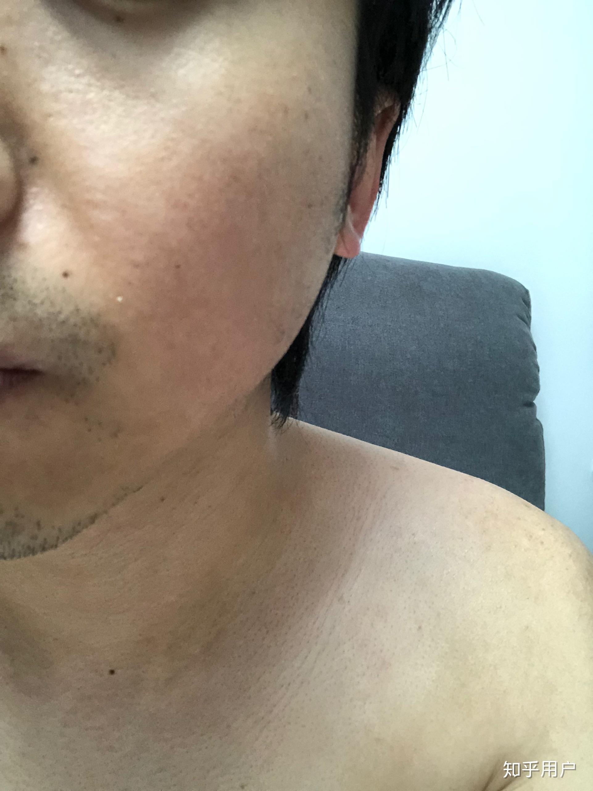 脸部毛周角化症怎么破? - 知乎