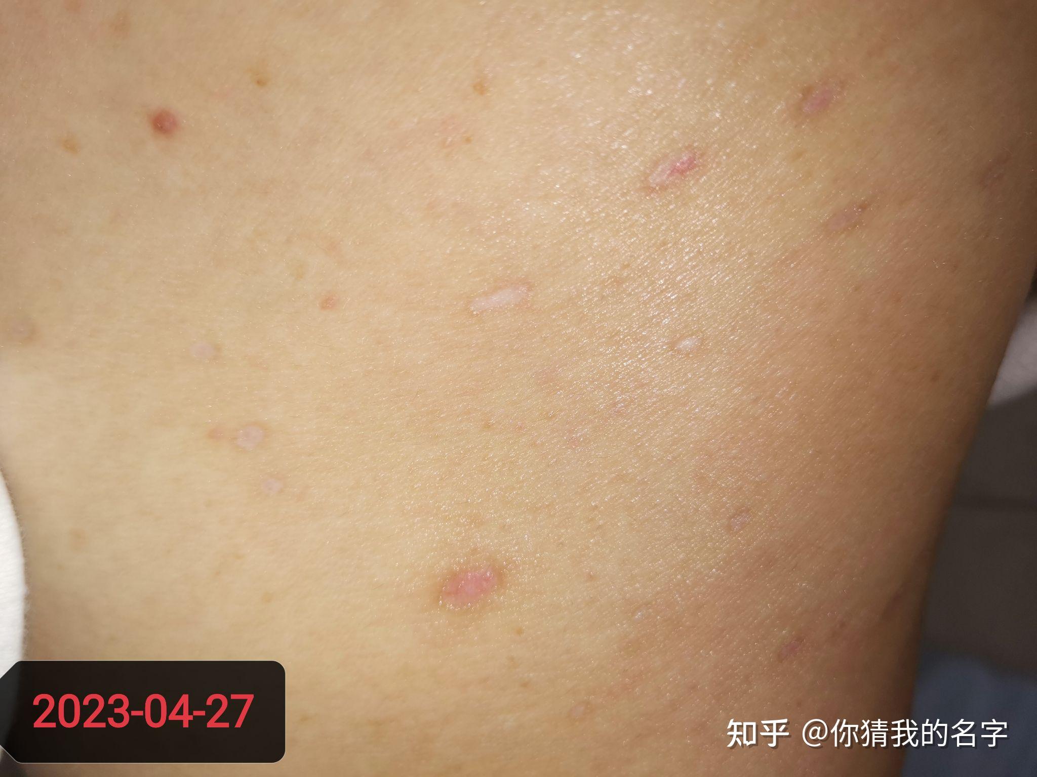 皮赘/疣 Skin Tag - Derma Revive