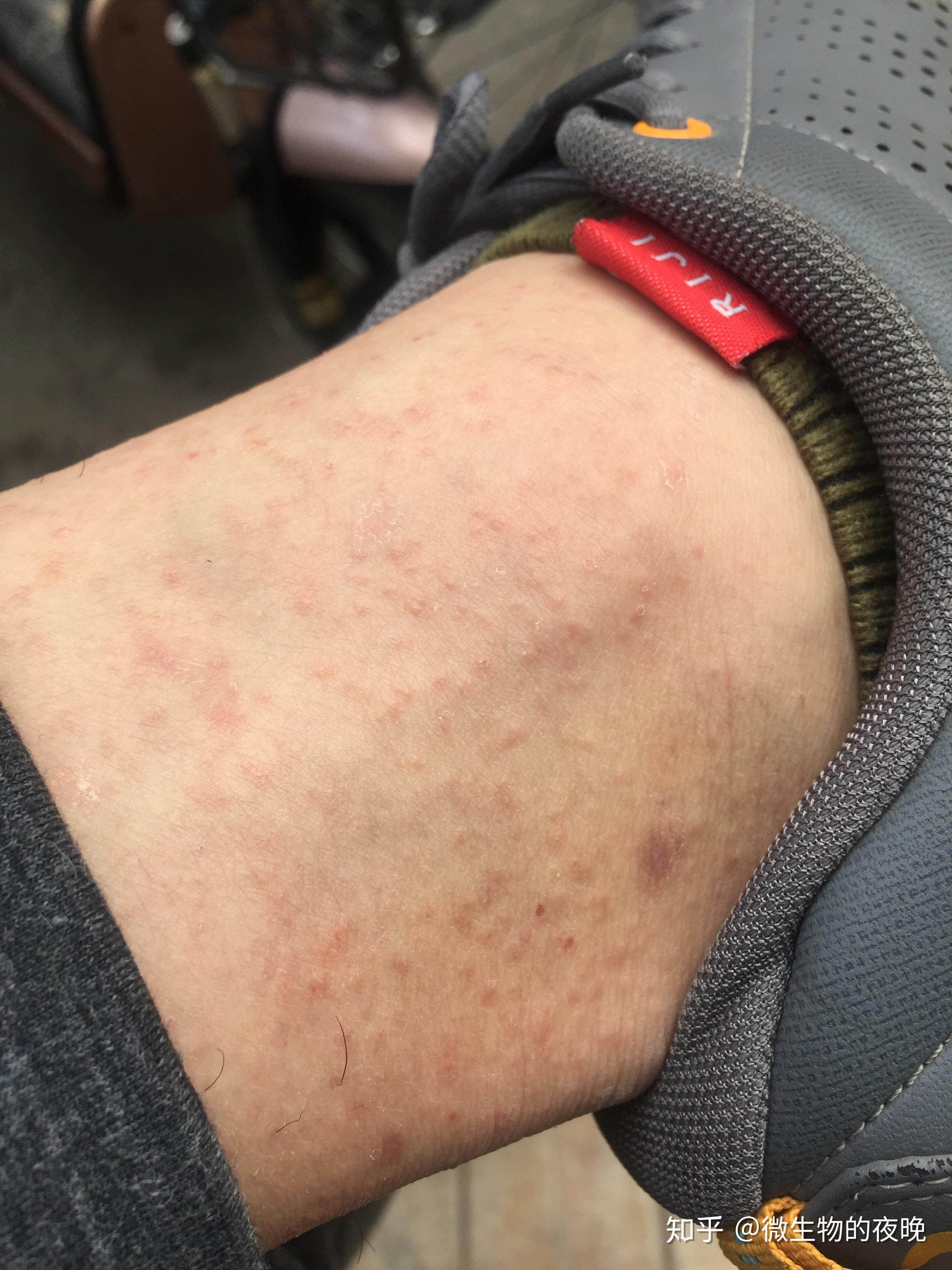 我的皮肤病湿疹一直没有放弃治疗