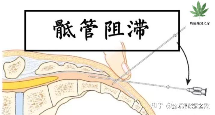 骶管注射解剖图图片