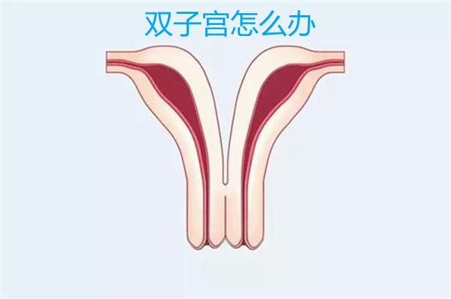 双子宫怎么办 - 知乎
