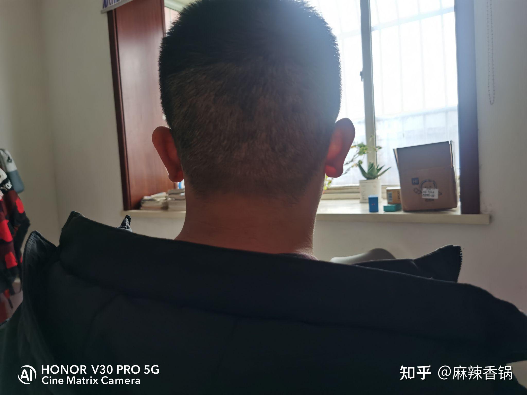中山植得植发靠谱吗(广东省中山哪里有植发)