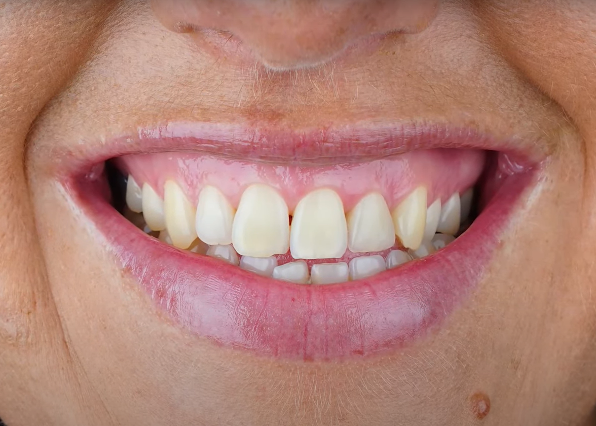 有人笑会露出上牙牙龈,有的人却不会,是因为什么? - 知乎