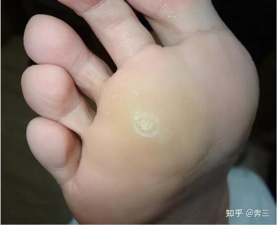 修鸡眼一般要多少钱? - 知乎