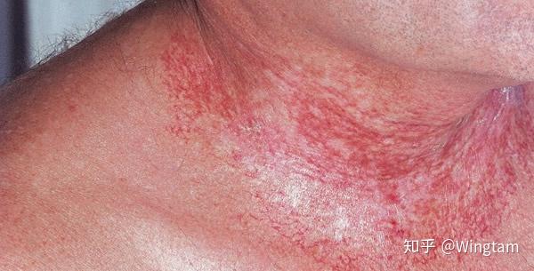 放射性皮炎的症状与放射性射线照射剂量成正比.