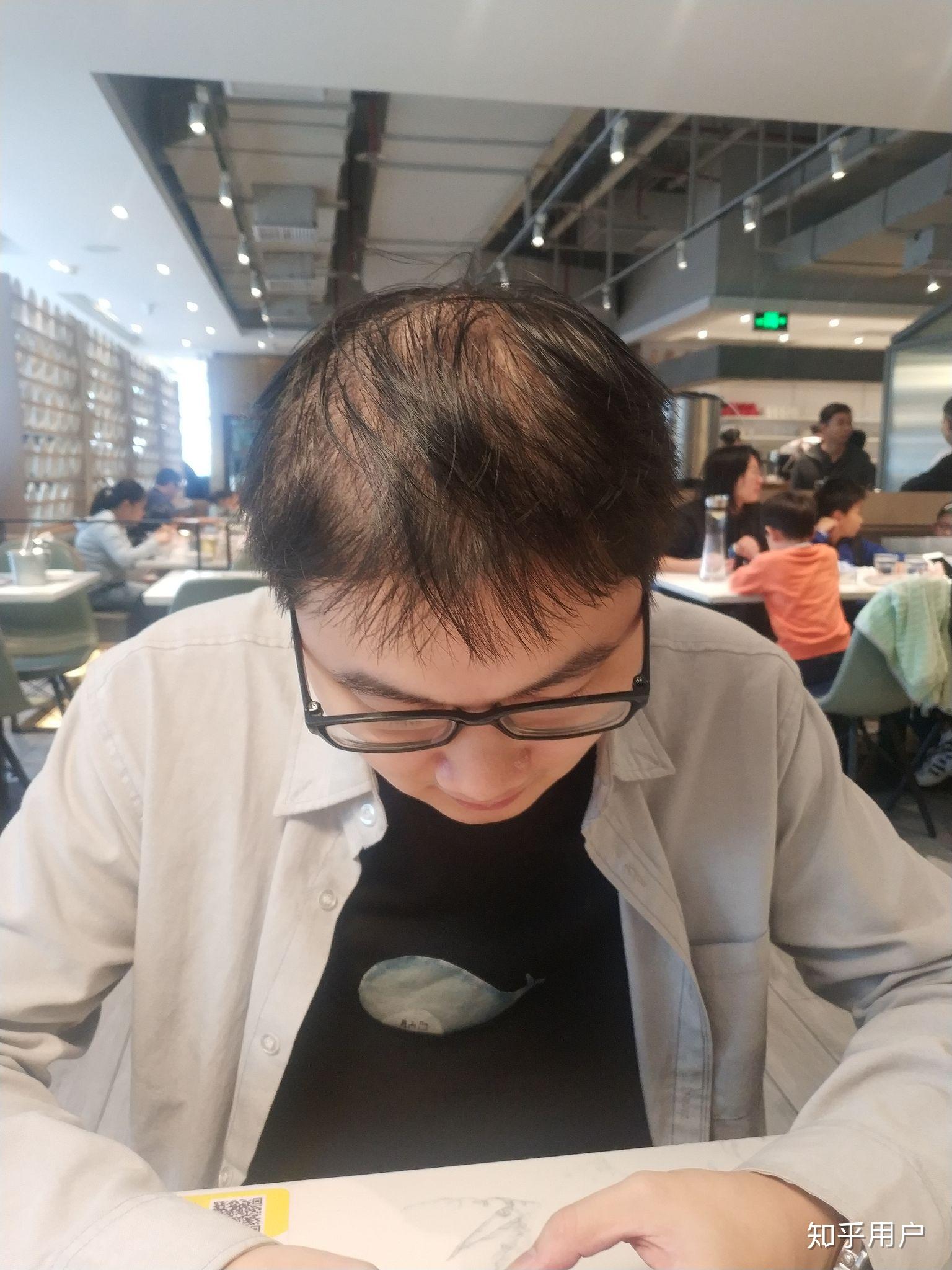 男生头发少,还会找到女朋友吗? - 知乎