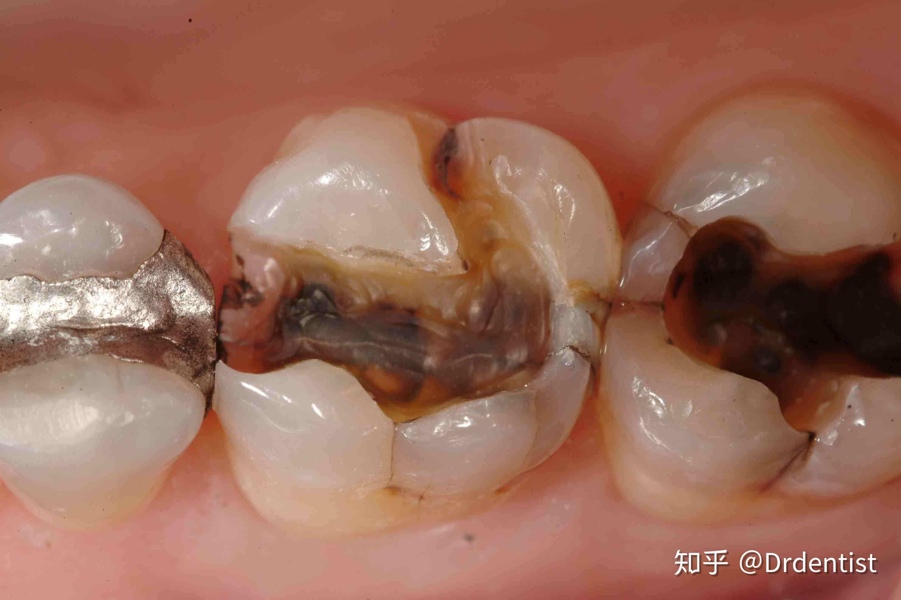 牙医怎么发现患者牙隐裂的?