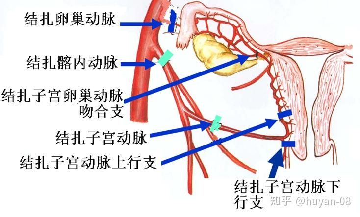 产妇大出血,为什么要切除子宫,而不是夹住子宫供血的静脉和动脉?
