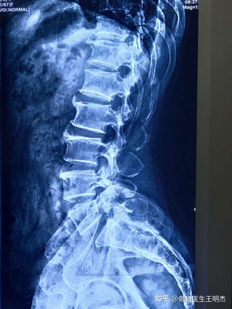 腰椎滑脱可以不手术吗? - 知乎