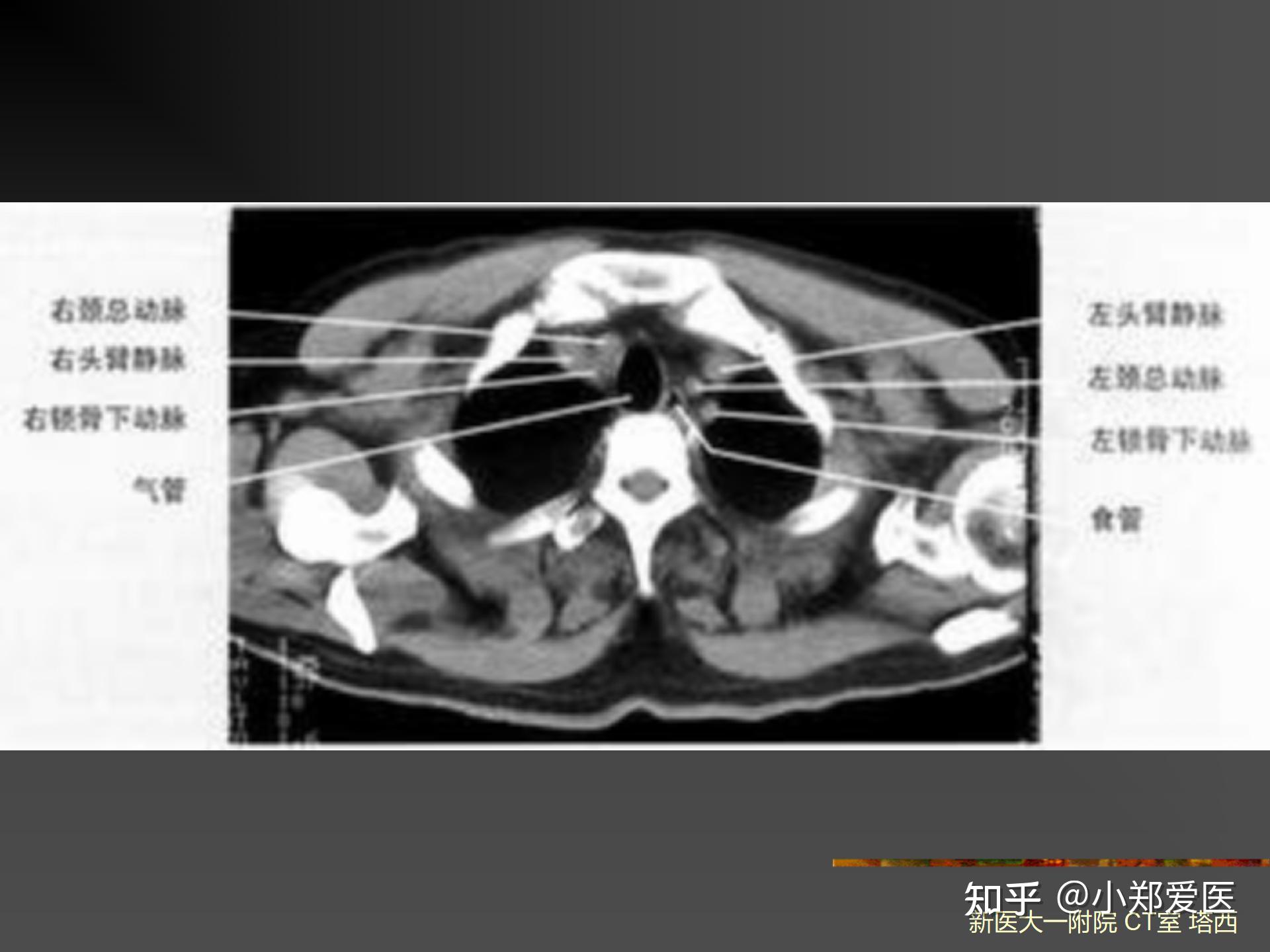 从0到1带你学会读CT片之呼吸系统影像学诊断(科普) - 知乎