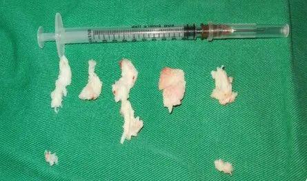 经椎间孔镜髓核摘除术,术后第二天即可下床活动?