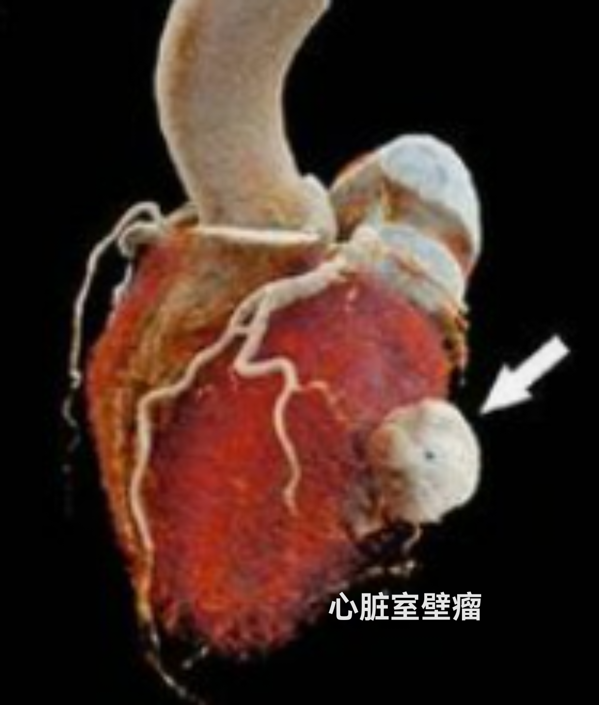 得了心肌梗塞并发左心室室壁瘤有哪些明显症状?