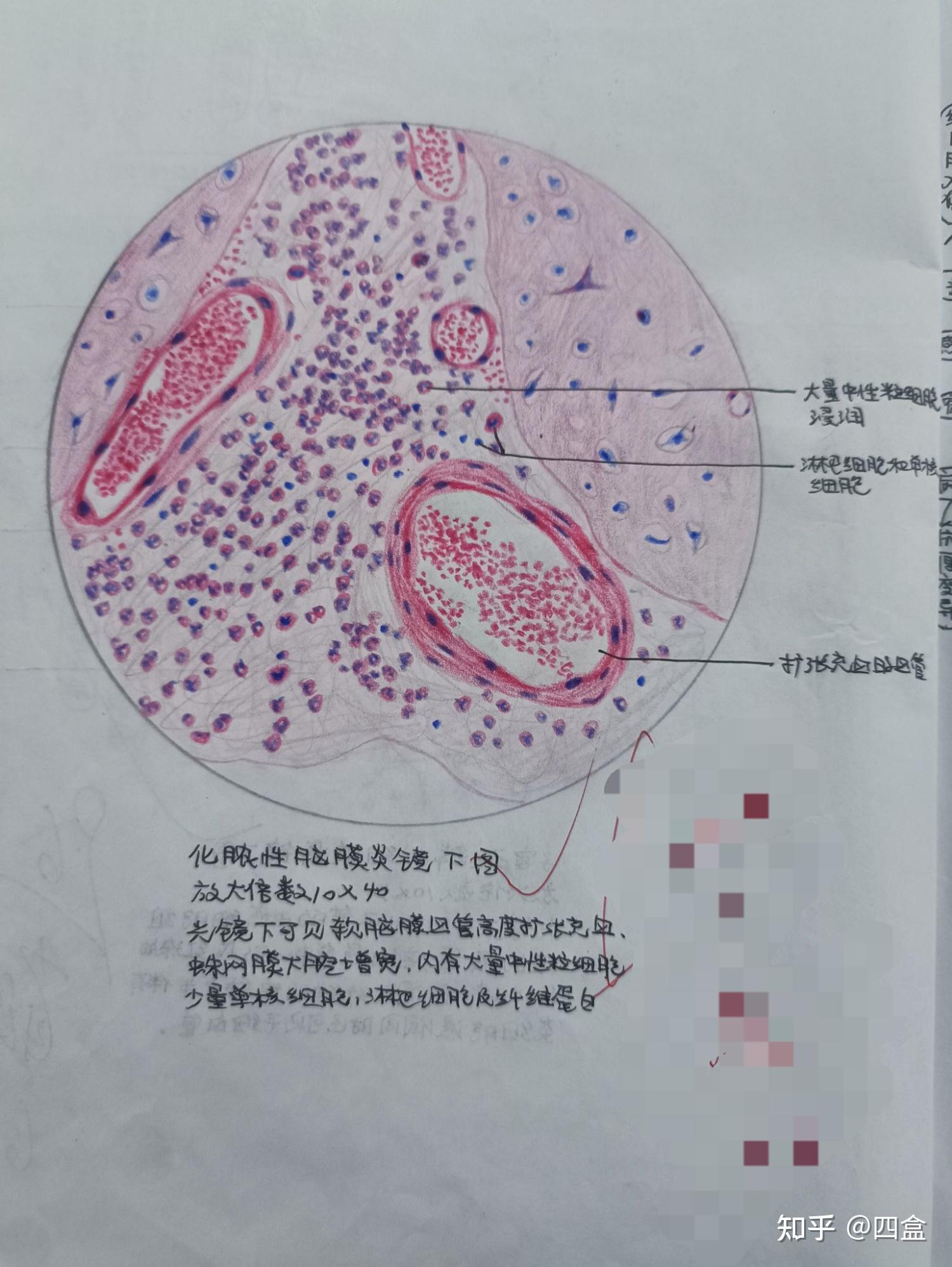 炎症细胞红蓝铅笔绘图图片