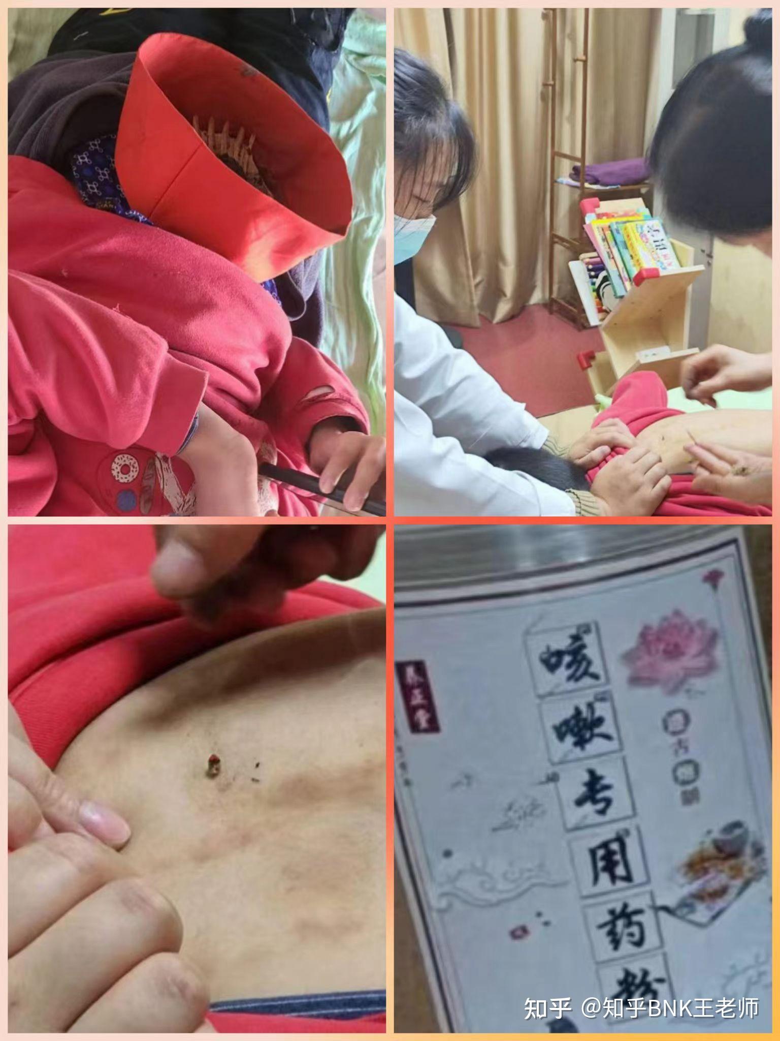 经过一周调理,没有任何症状通过推拿 鳖甲灸 麦粒灸发烧 咳嗽 精神