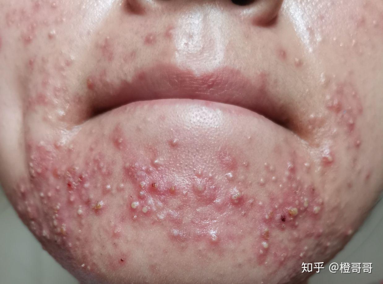 阿达帕林治闭口粉刺的经历