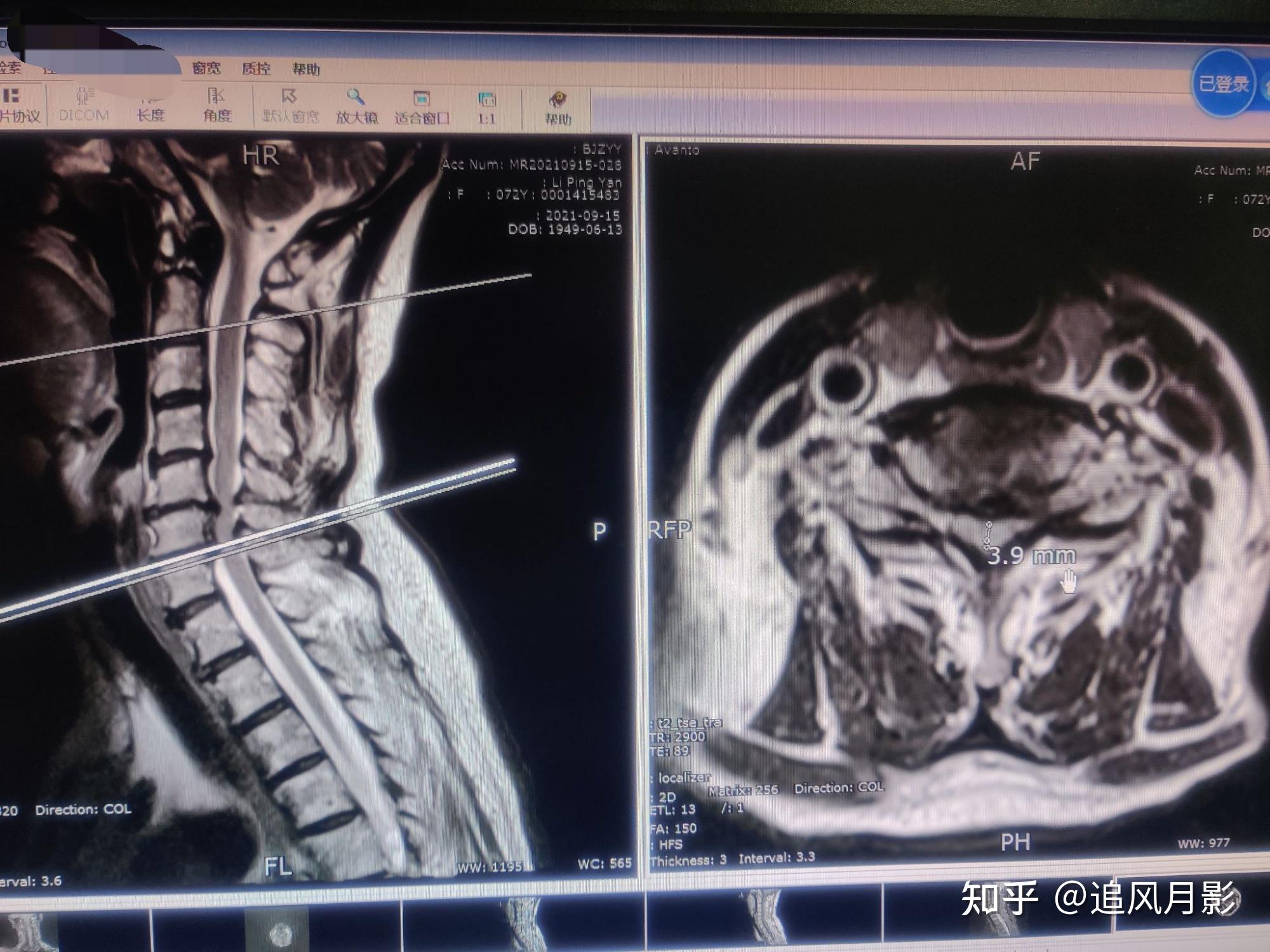 脊髓型颈椎病影像图片