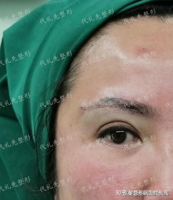 40岁50岁眼尾下垂三角眼来看看她们提眉手术后的真实情况