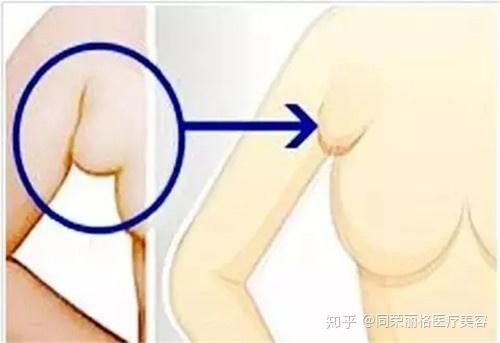 副乳 是怎么回事 潜在的危害你都知道吗 知乎