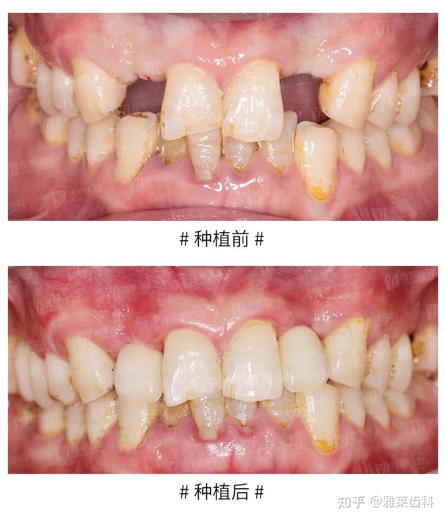 雅莱齿科种植牙案例分享