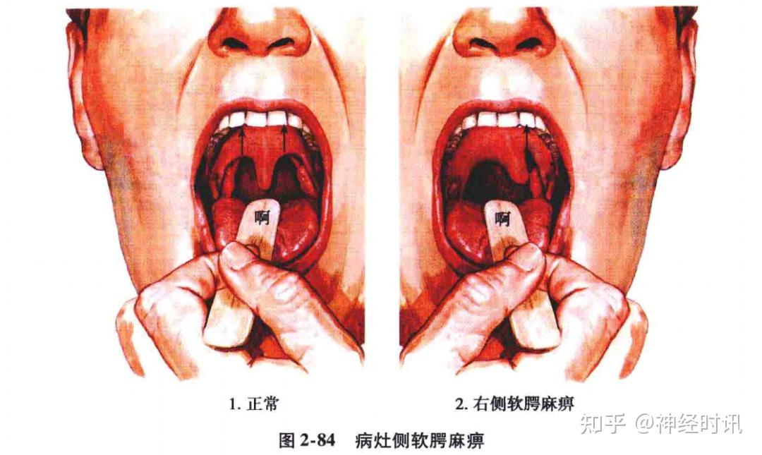 (1)疑核及其发出的纤维损伤:表现为声音嘶哑,饮水呛咳,吞咽困难,病灶