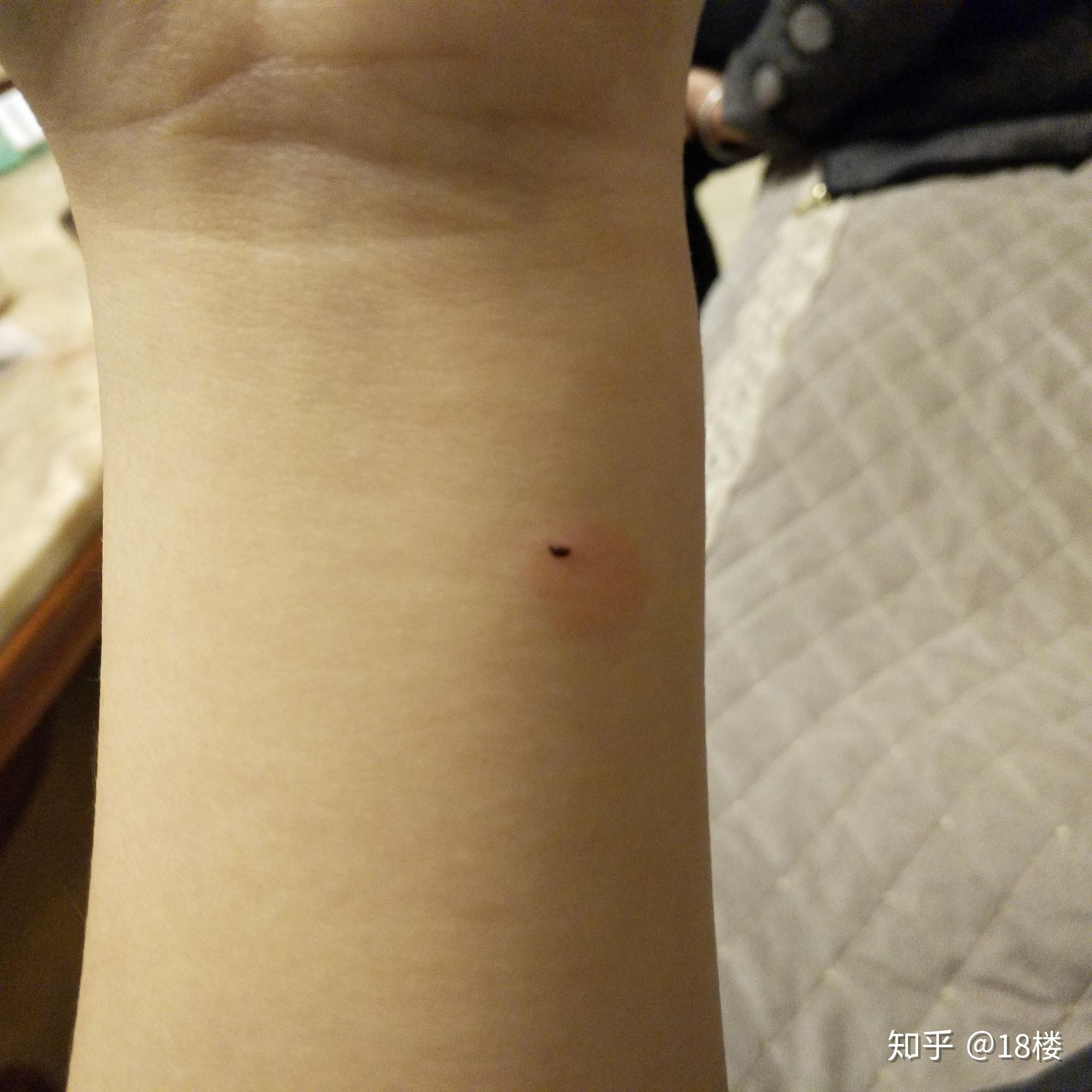 结核皮试出现如下状况,是啥结果呢?