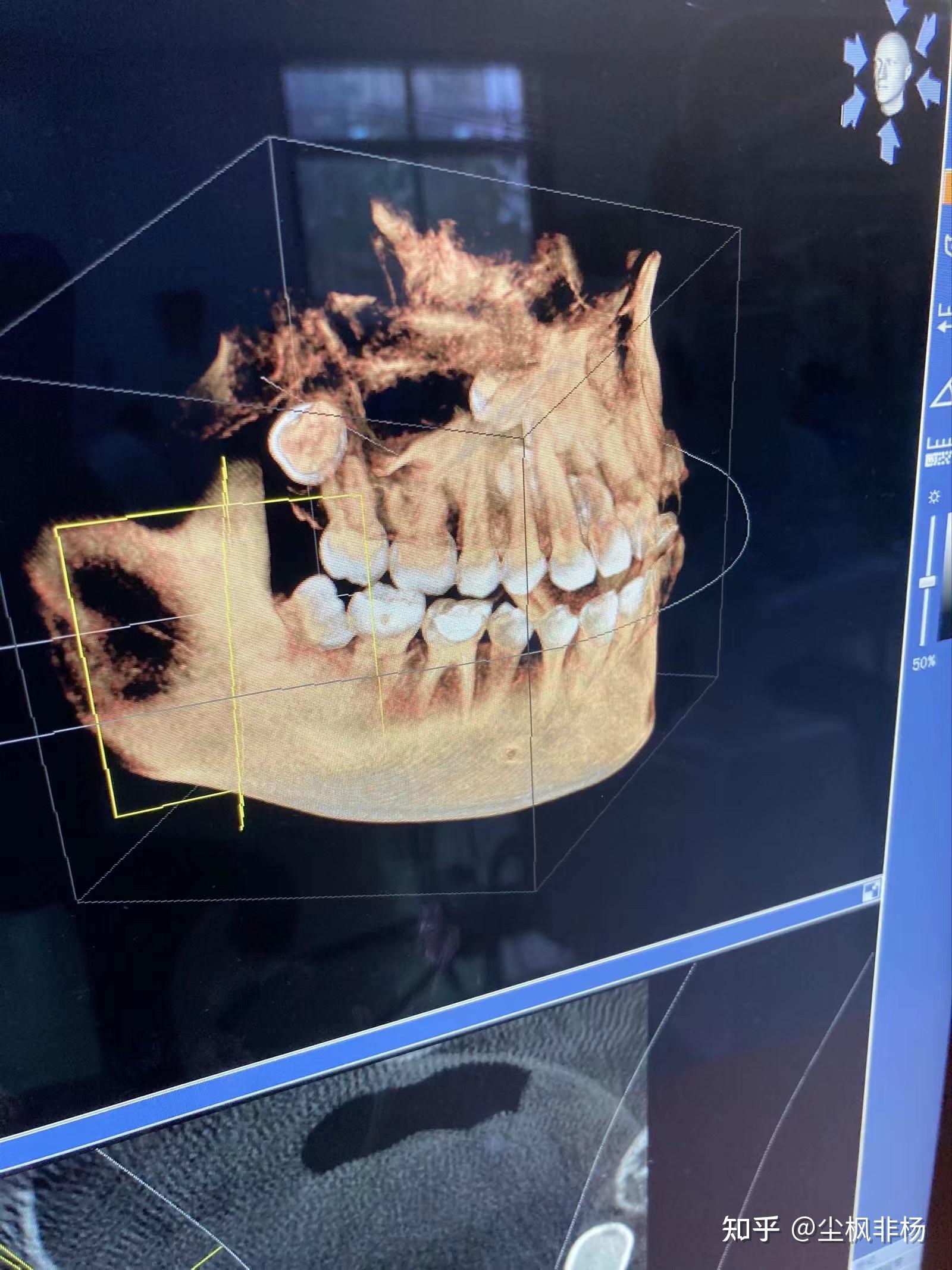 拔横着长的智齿是怎样的体验