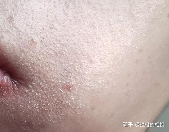 脸上死皮去多了会怎样? - 知乎