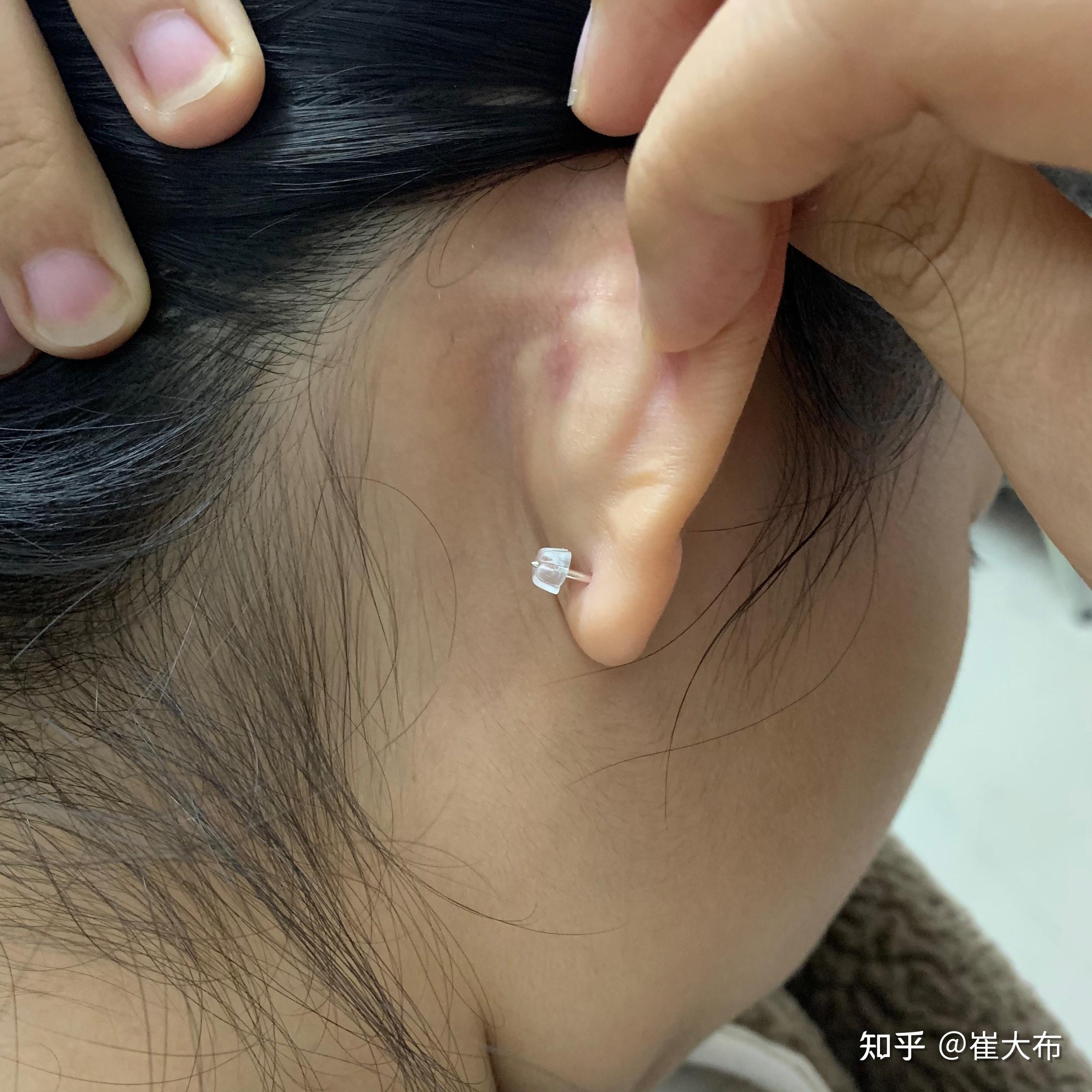 厚耳垂打耳洞是一种什么样的体验,会很疼吗? - 知乎