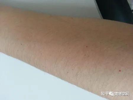 皮肤管理 手臂上有红点是怎么回事 知乎