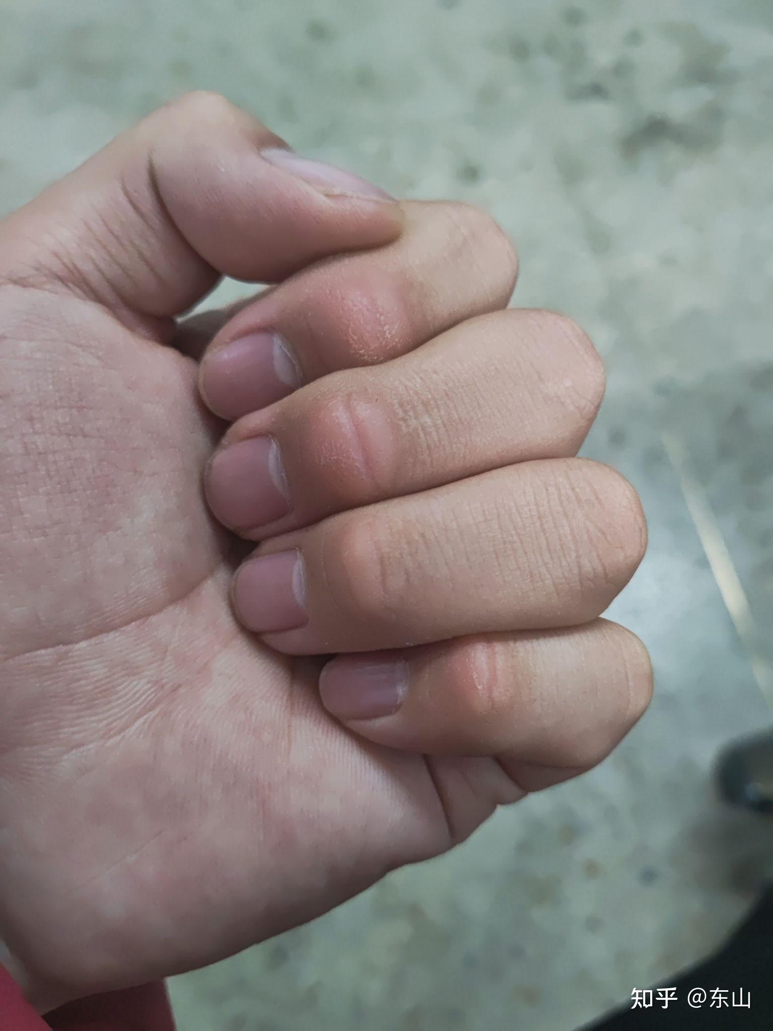 为什么手指关节上会长一些像是茧子的死皮? 
