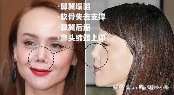 明星网红同款猪鼻子还能救？看这个欧巴怎么修好的! - 知乎