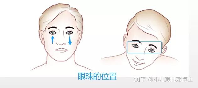 孩子歪脖子治不好可能是斜视惹的祸