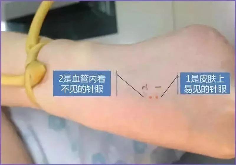 如果输液时空气进入了血管病人会怎么样