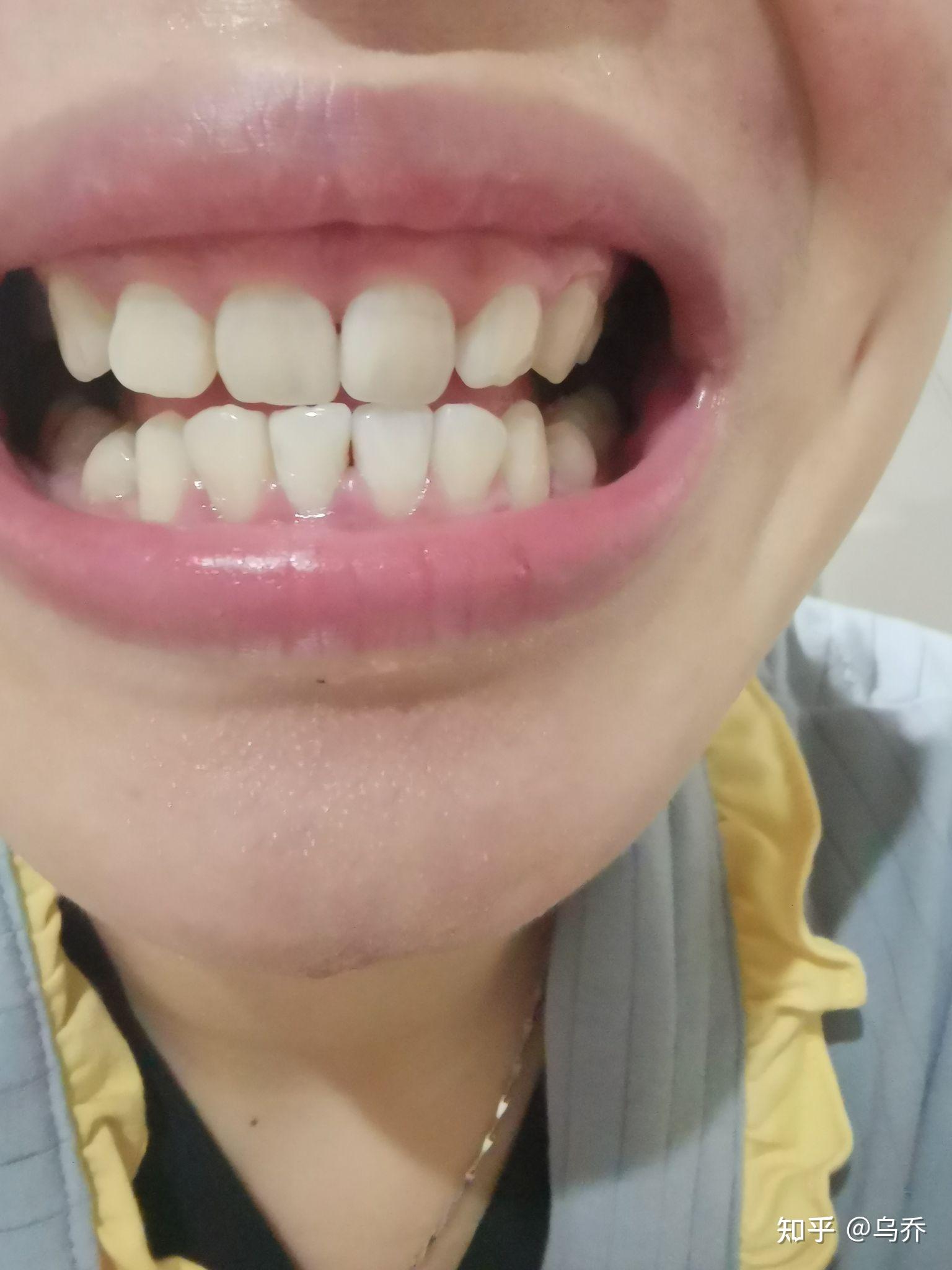 正畸后留下黑三角牙龈萎缩的你们还好吗