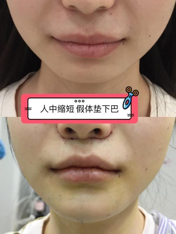 人中缩短熬过7天就完美了