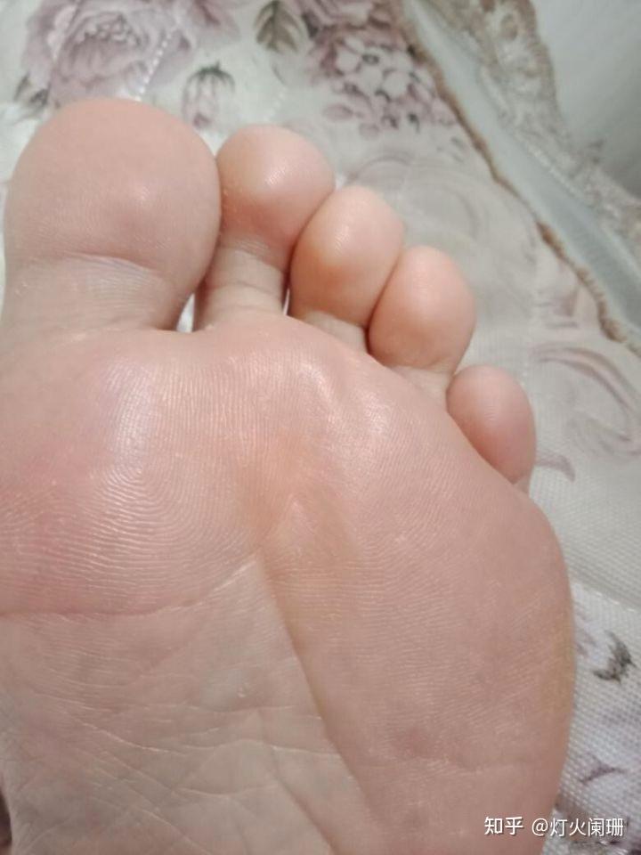 为什么脚气很难治愈