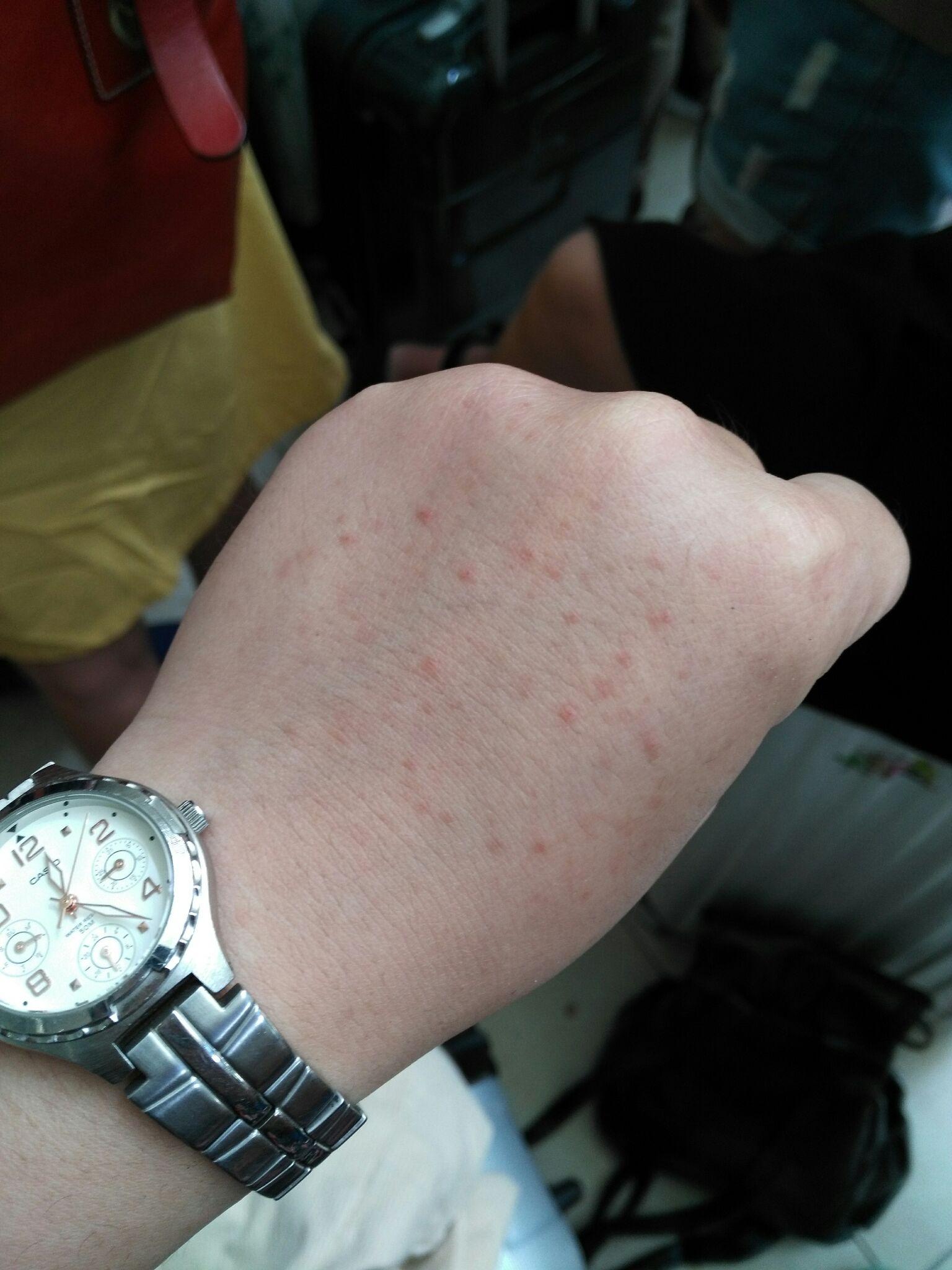 去越南芽庄游泳手部过敏起水泡斑点怎么办?