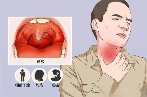 咽喉炎最直接的症状就是喉咙痒,痛,也会伴随喉咙异物感,时常清喉咙