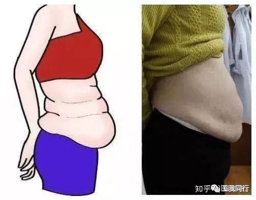 女性生完孩子后肚子松松垮垮腹直肌分离怎么办怎么办