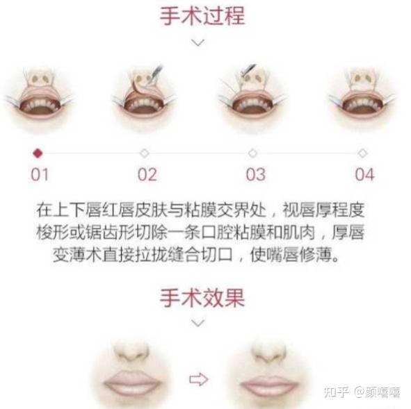 厚唇改薄、玻尿酸丰唇、M唇价格便宜吗?效果、手术流程全解,想唇部改善的进