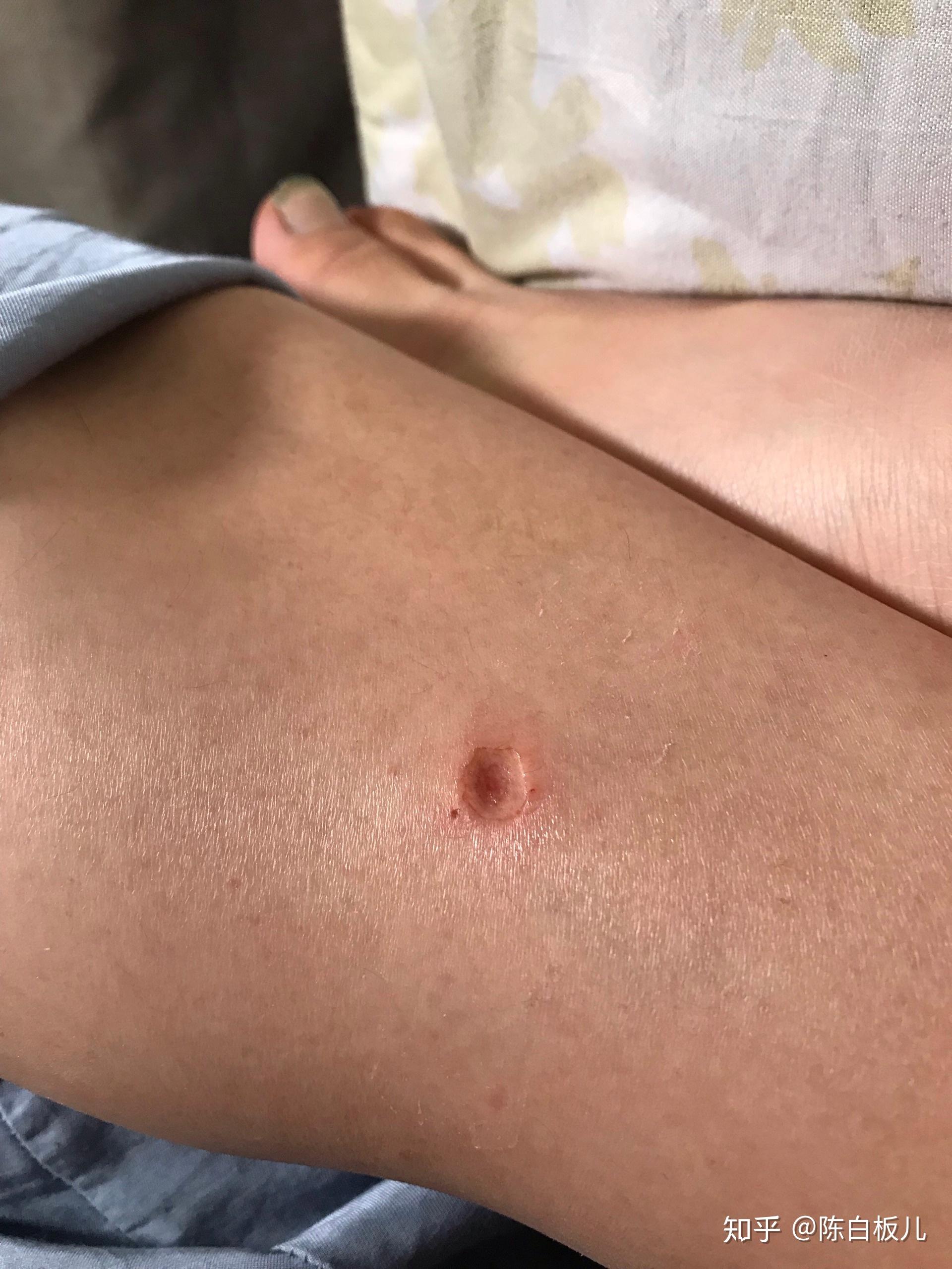 激光祛疣后如何避免留疤? - 知乎