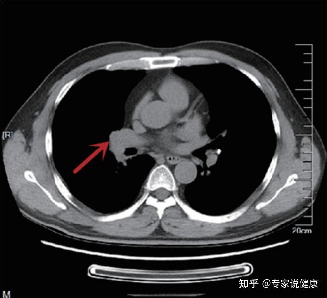小细胞肺癌无法治疗依靠这个疗法至今7年仍未复发