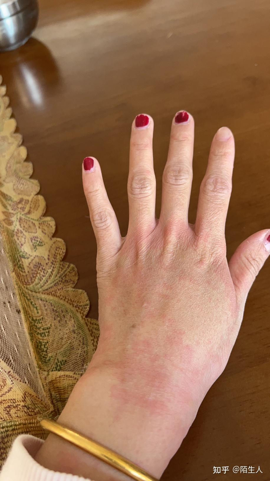 急性荨麻疹第一天痛苦经历史 - 知乎