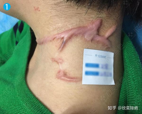 儿童烫伤疤痕为什么容易增生