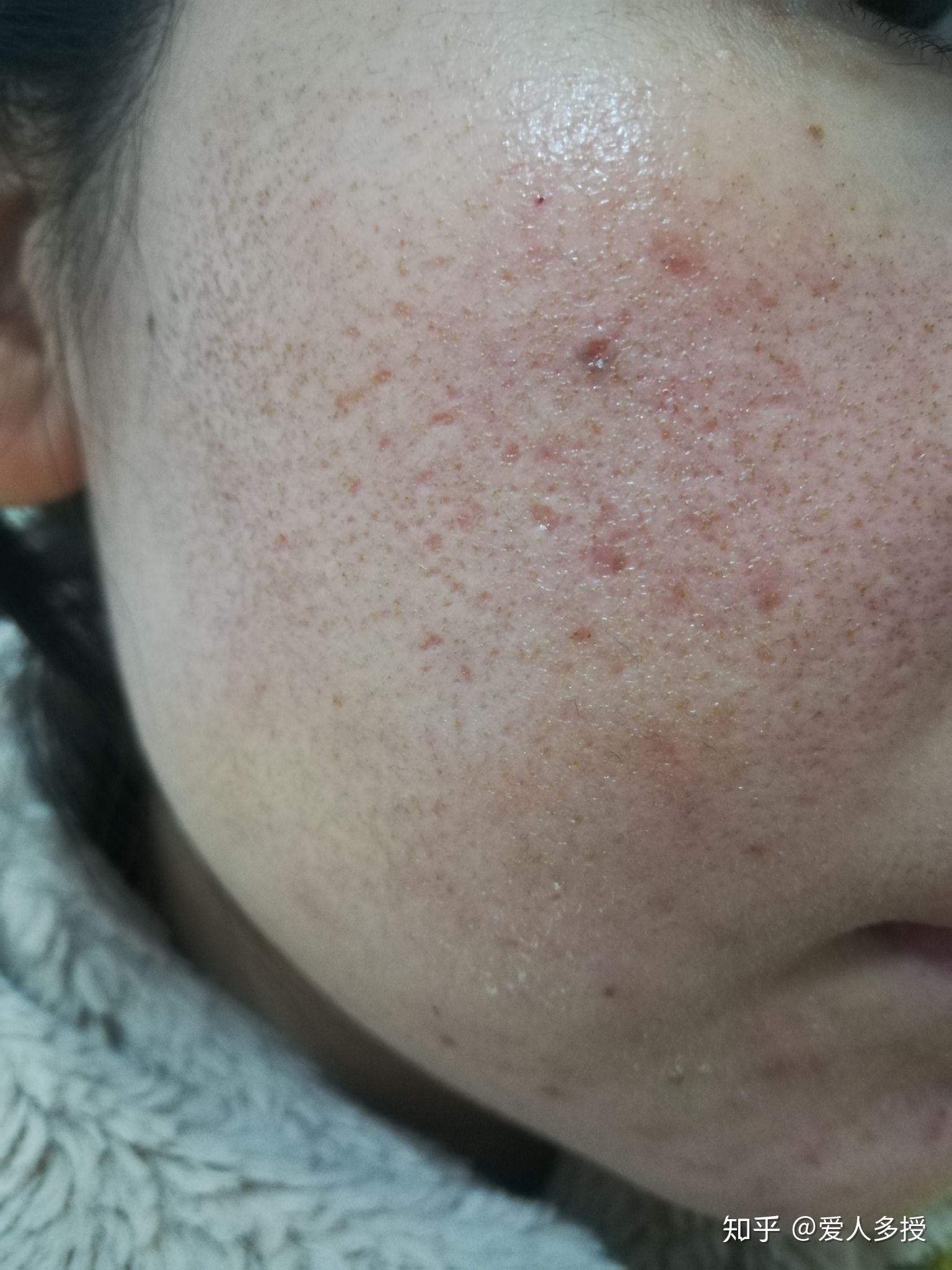 用什么可以祛痘坑 v2-31105a681f59dfc914770cc3723d087c_r.jpg